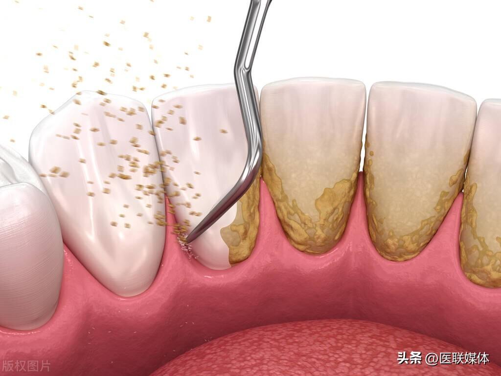 牙缝里长了牙结石，能不能自己抠掉？(图3)