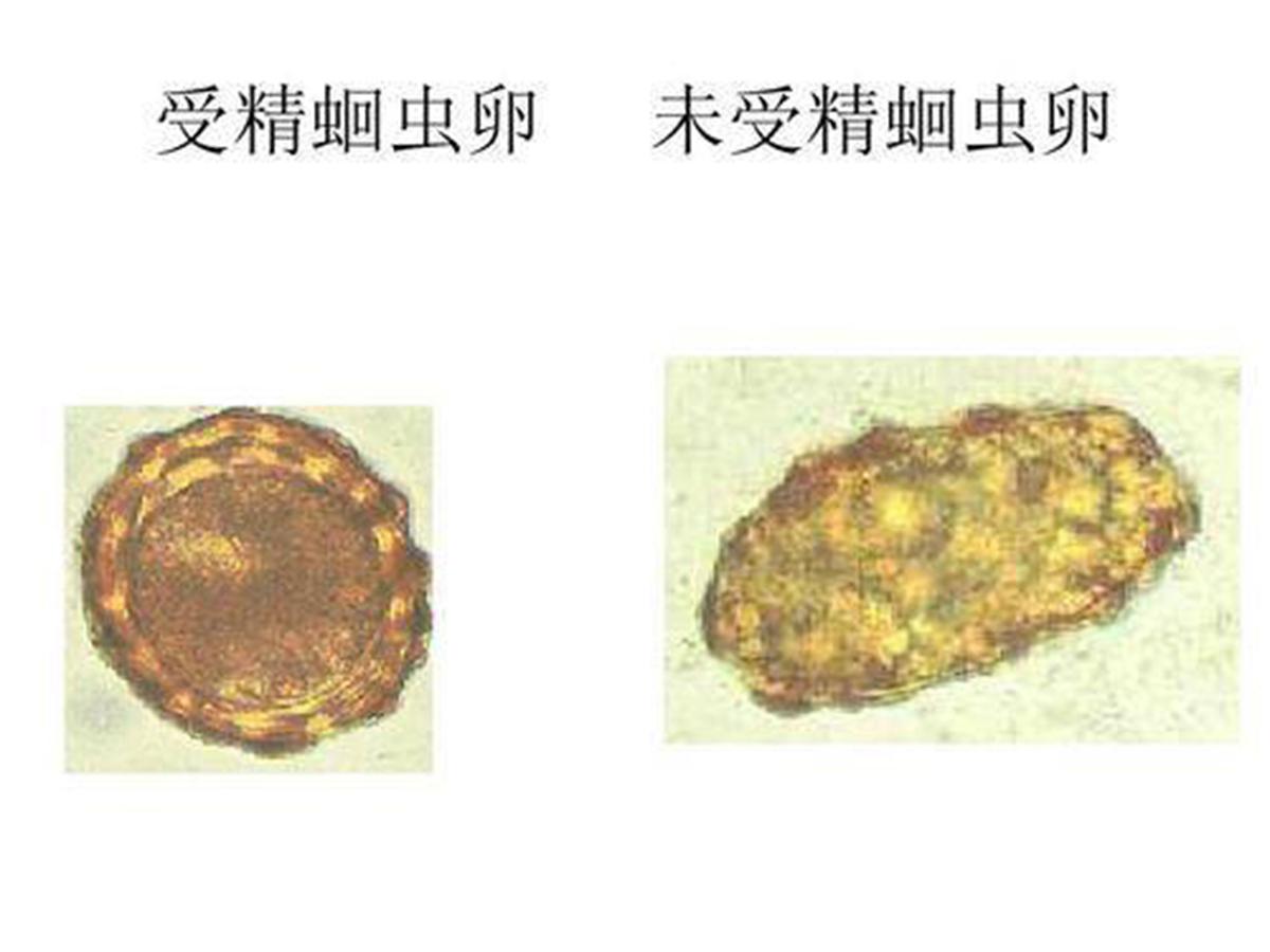 七八十年代，几乎每人肚里都生过蛔虫，为啥现在却没人感染蛔虫了(图7)